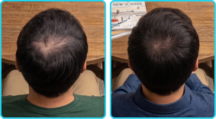 iHarvest customer before and after hair regrowth result