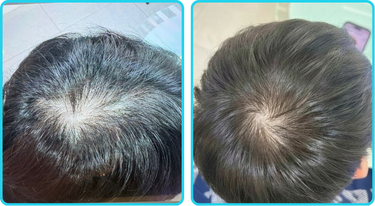 iHarvest customer before and after hair regrowth result