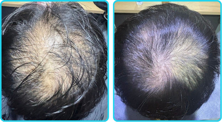 iHarvest customer before and after hair regrowth result
