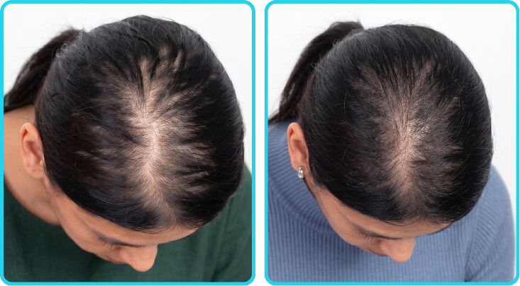 iHarvest customer before and after hair regrowth result